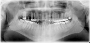 Panorama-Röntgenaufnahme Implantat im Oberkiefer